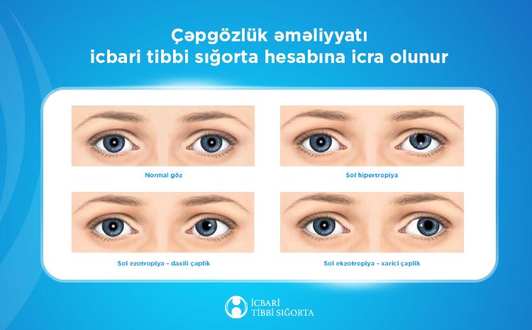 Çəpgözlük əməliyyatı icbari tibbi sığorta hesabına qarşılanır 
