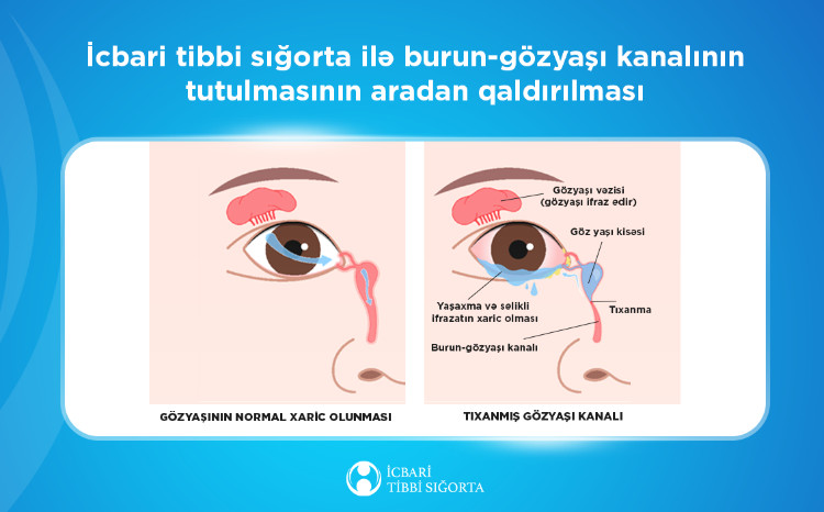 Gözyaşı axarının bərpası məqsədi ilə 234 oftalmoloji əməliyyat icra olunub 