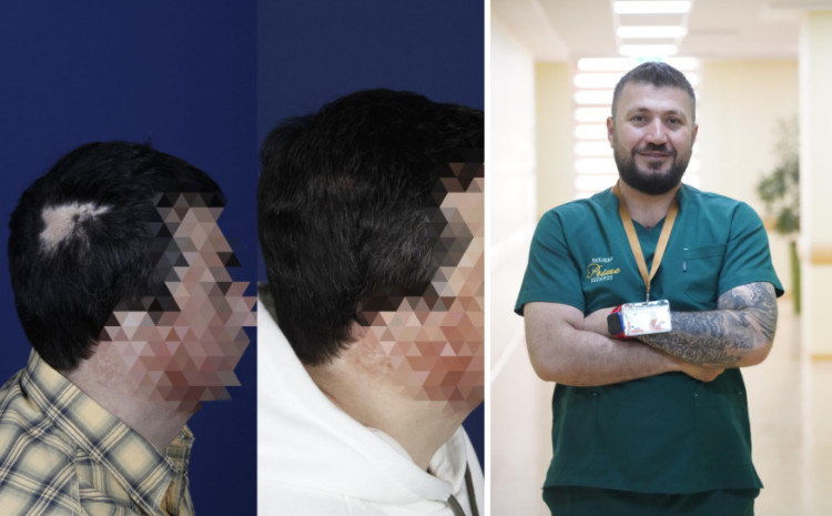Yanıq sonrası saç əkimi: Çətin, amma mümkün 